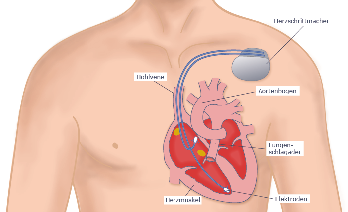 Herzschrittmacher schema des gra de.png